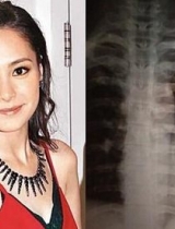 阿娇自曝拍戏受伤后的X光片：脊椎真的是各种歪